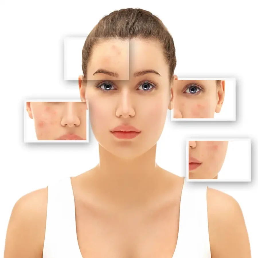 Acne & Pigmentation